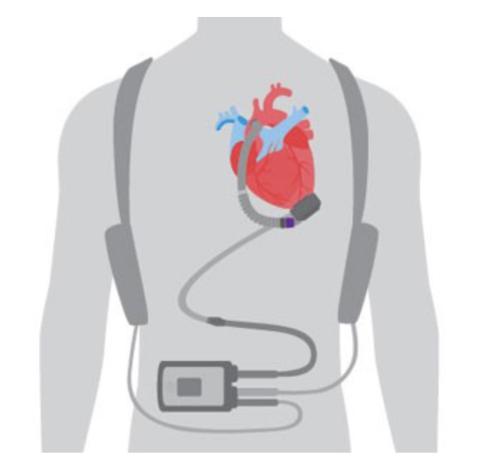 A graphic of a ventricular assist device attached to a heart.