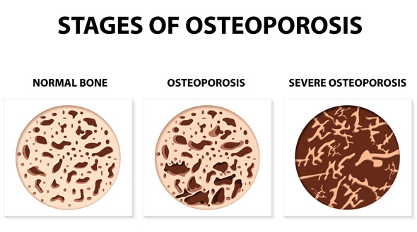 Diagram shows what the interior of bones look like when they have normal density, osteoporosis, and severe osteoporosis