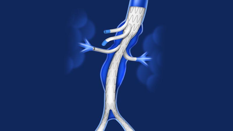 diagram of the device that is placed in the aorta during a FEVAR procedure